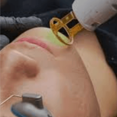 Full Face Laser Series at Luxurious Beauty Studios in West Hempstead, NY